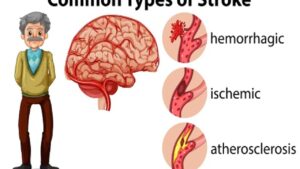 Facts About Strokes