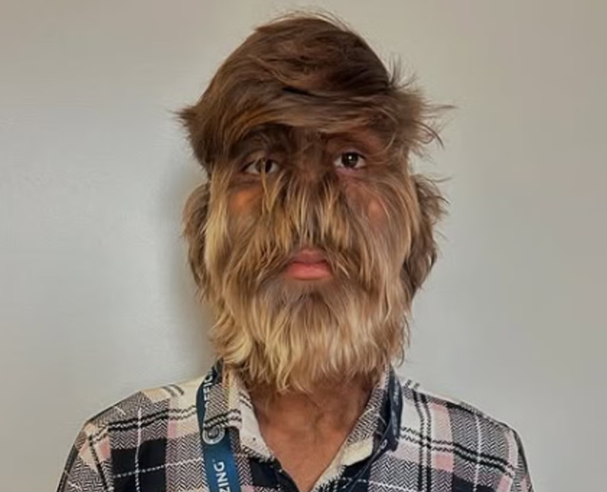 Indian boy makes Guinness World Record for hairiest face