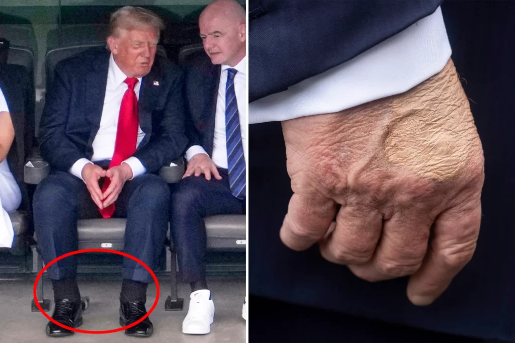 US president Trump diagnosed with chronic venous insufficiency following leg swelling