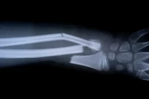 Chinese scientists develop ‘bone glue’ that heals fractures in minutes