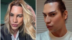 Brazilian Influencer Junior Dutra Dies After Alleged Complications From ‘Fox Eyes’ Surgery