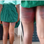 Call for justice after SS3 student was allegedly beaten brutally at Command secondary school Iyana Ipaja