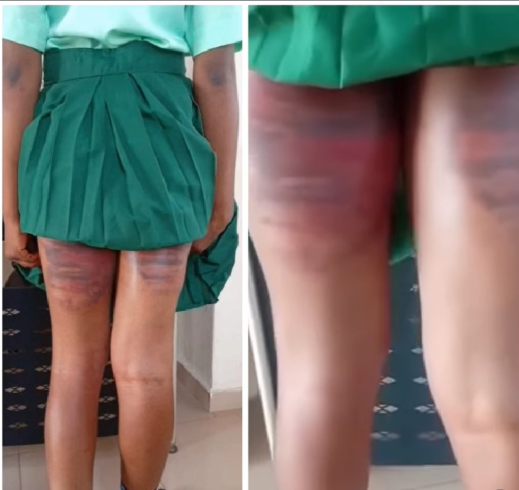 Call for justice after SS3 student was allegedly beaten brutally at Command secondary school Iyana Ipaja